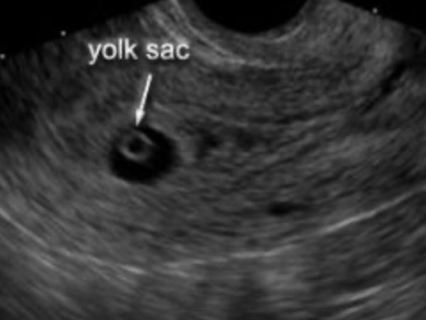 They Told Me to Prepare for a&nbsp;Miscarriage